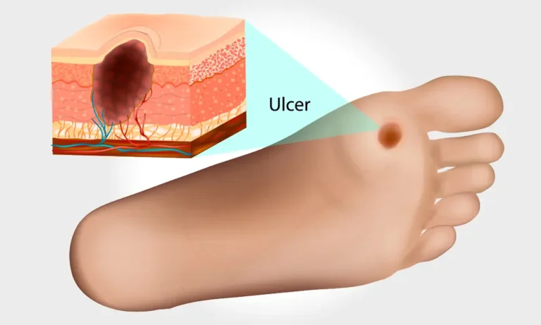 Diabetic Foot Ulcer